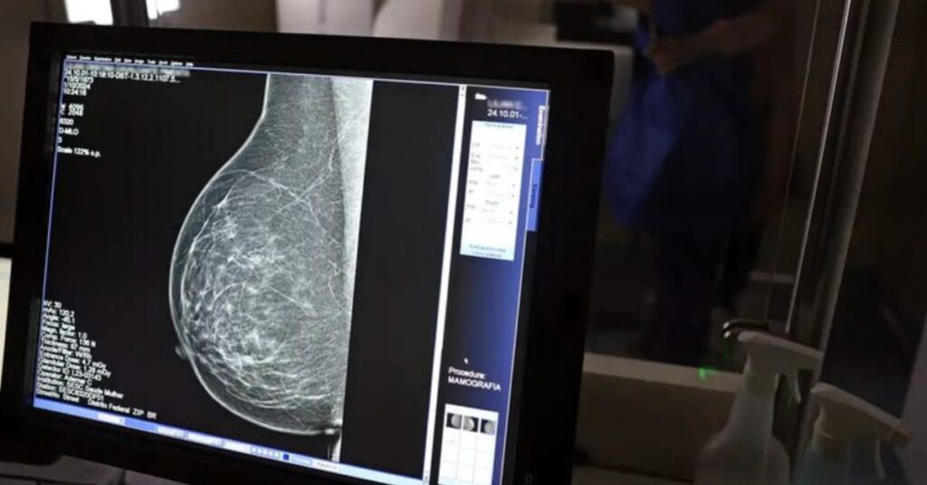 Exame de mamografia em tela de computador reforça importância da detecção do câncer de mama