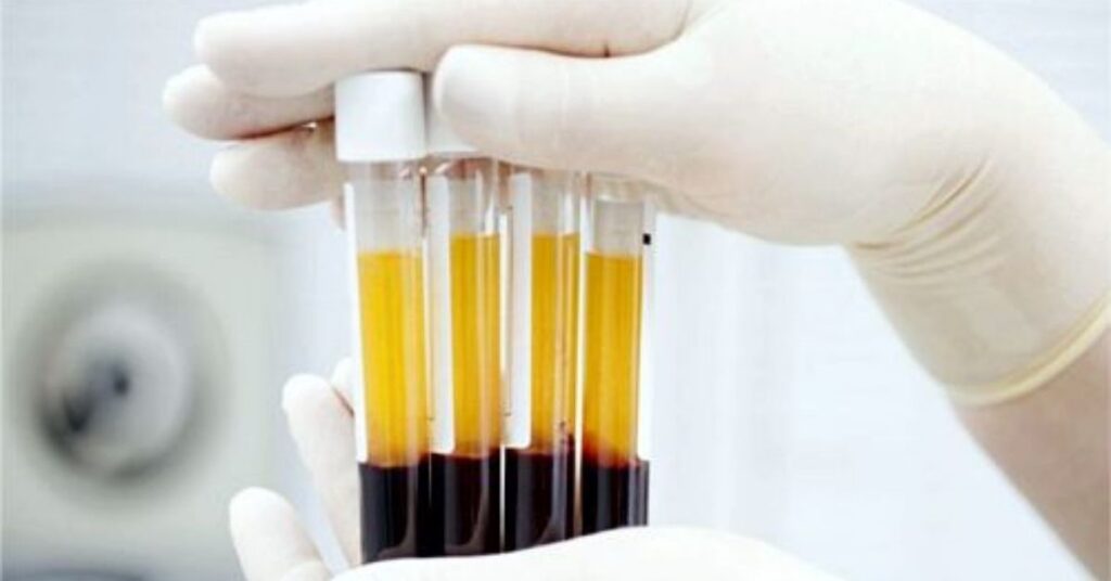 amostra do sangue mais raro do mundo em tubos de laboratório