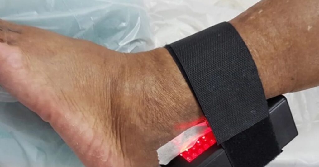 Curativo com LED desenvolvido pela UnB para tratar o pé diabético e ajudar a reduzir amputações por diabetes.