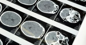 Suplementos contra tumor cerebral agressivo em imagens de glioblastoma