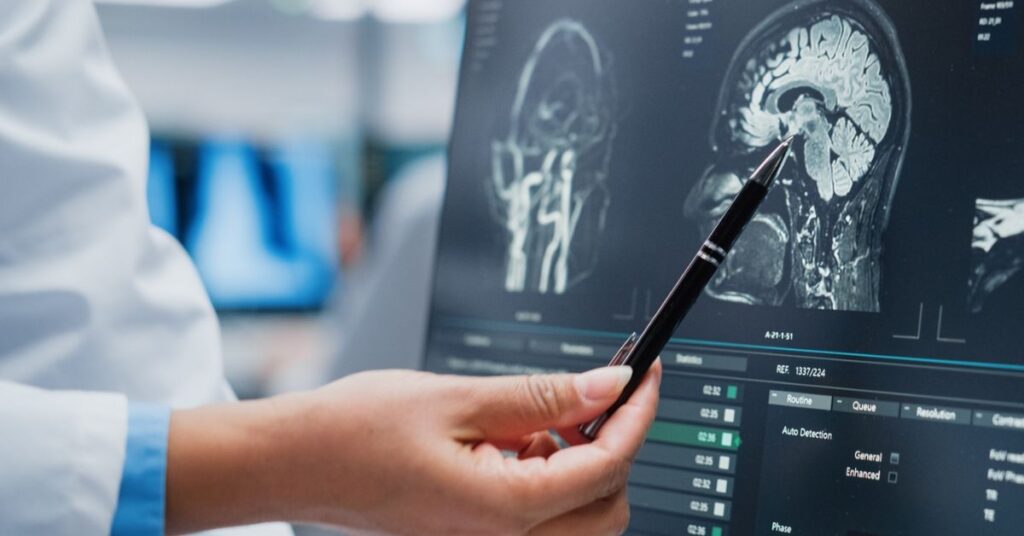 pesquisa em doenças raras com exame de imagem cerebral em centro especializado no Ceará