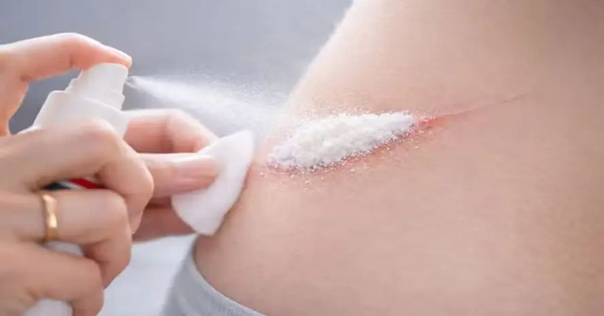 spray para estancar hemorragia aplicado sobre corte na pele