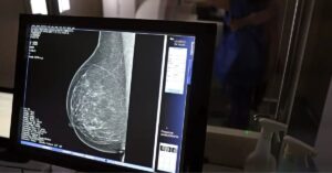 Mamografia com IA pode ajudar mulheres a descobrir risco cardíaco antes do infarto