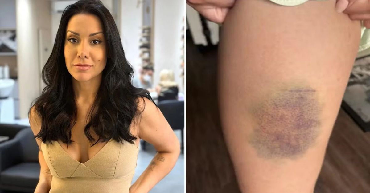 Jéssica Santos mostra hematoma na perna após impedir tentativa de estupro durante luta de 13 minutos em apartamento de Barueri
