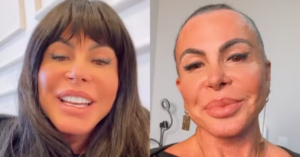 Gretchen expõe a alopecia feminina e incentiva mulheres a enfrentarem o problema sem tabu