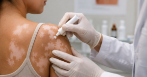 Tecnologia criada pela USP recupera pigmentação da pele em 15 dias em teste contra vitiligo