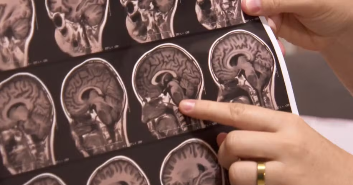 Exame de imagem do cérebro ilustra teste para tumor cerebral capaz de identificar o tipo da doença em menos de duas horas.